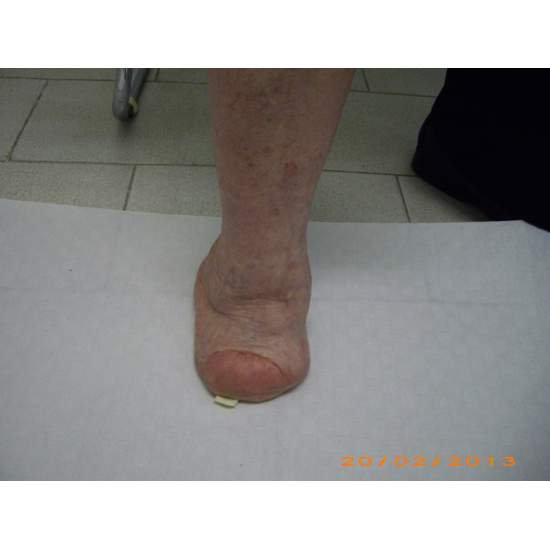 Many cases partial foot amputation