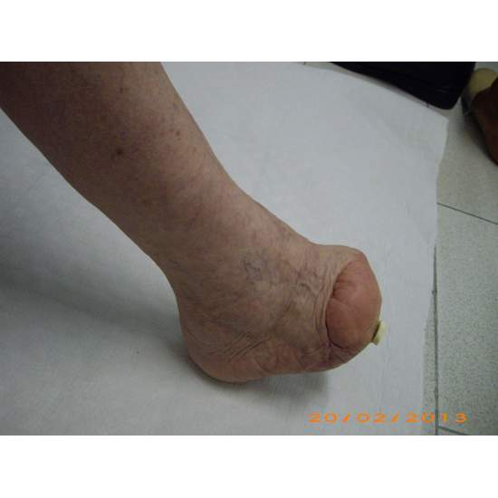 Muitos casos de amputação... 2