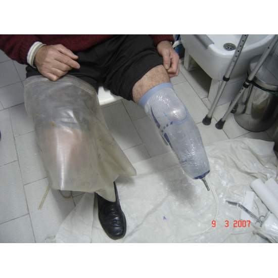 Lower limb amputation 2