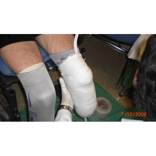 Bilateral amputation av... 2