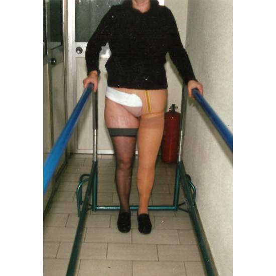 Hip disarticulation prostheses