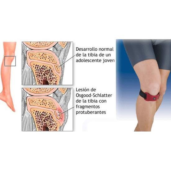 Enfermedad Osgood-Schlatter Orliman NOTICIAS