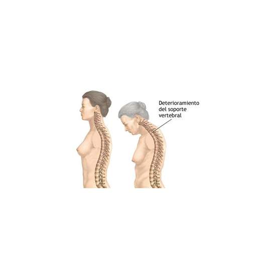 O que é osteoporose?