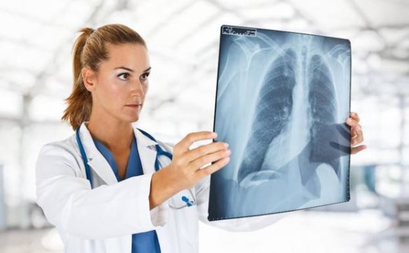 los-oncologos-piden-prioridad-para-el-cancer-de-pulmon-por-su-mortalidad