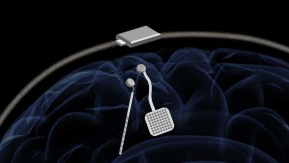 inventan-un-marcapasos-inalambrico-para-el-cerebro-que-trata-los-trastornos-neurologicos