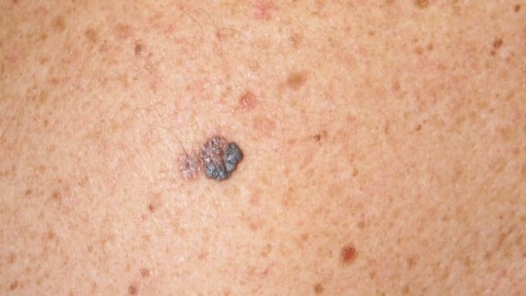 un-farmaco-espanol-muestra-eficacia-ante-determinados-tipos-de-cancer-melanoma-tumor-de-pulmon-y-renal