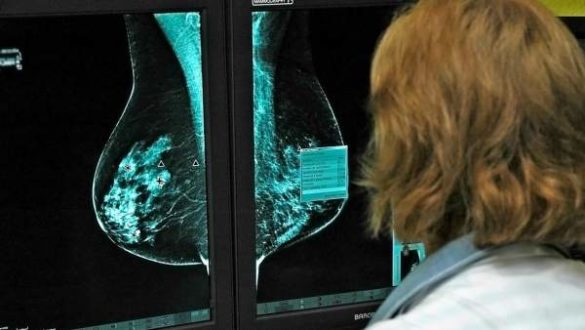 confirman-el-nexo-entre-el-cancer-de-prostata-mas-agresivo-y-el-de-mama
