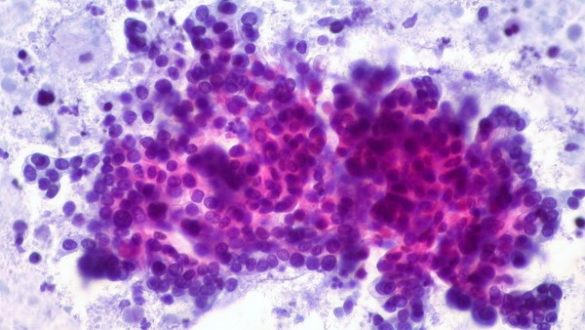 desarrollan-un-nuevo-metodo-para-la-deteccion-del-cancer-de-pancreas