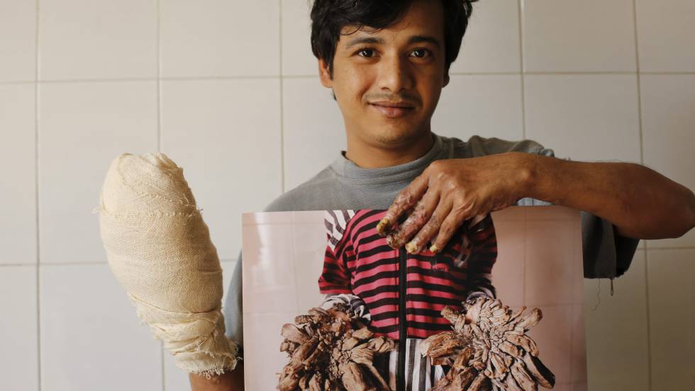 Abul Bajandar, conocido como 'hombre árbol', muestra una fotografía de sus manos antes de ser operadas.