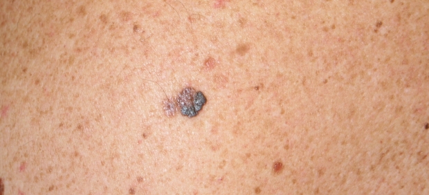 Melanoma