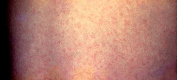 erupción por rubeola