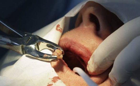 un-odontologo-tendra-que-pagar-99.000-euros-por-dejar-sin-dientes-a-una-paciente