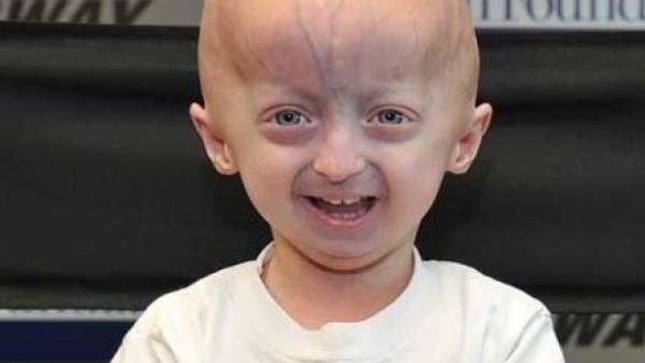 que-es-la-progeria-la-enfermedad-rara-que-produce-el-envejecimiento-rapido-de-los-ninos
