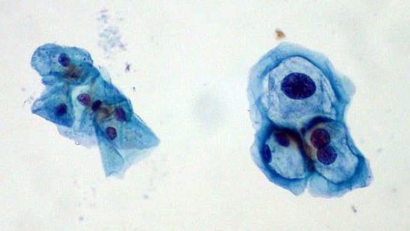 dos-tipos-de-virus-vph-asociados-con-el-cancer-cervical-han-disminuido-desde-la-aparicion-de-la-vacuna