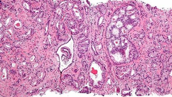 por-que-el-cancer-de-prostata-afecta-mas-a-galicia-asturias-y-el-sudoeste-de-andalucia