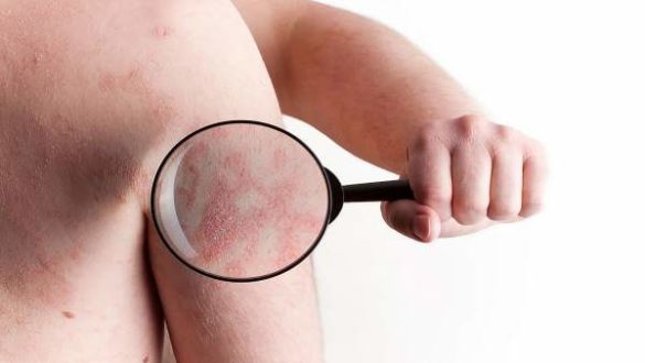 la-psoriasis-tipos-sintomas-y-tratamientos-para-reducir-los-efectos