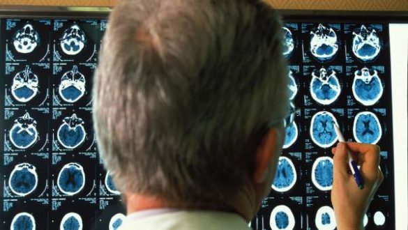 un-estudio-encuentra-relacion-entre-la-diabetes-no-tratada-y-el-alzheimer