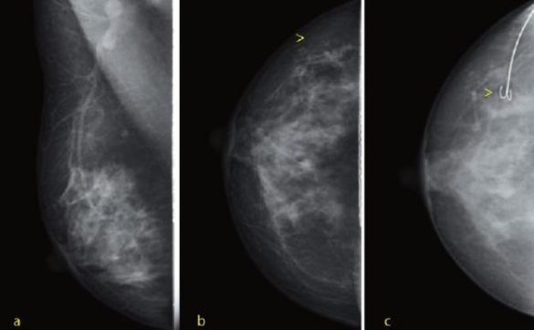 aumentan-los-casos-de-cancer-de-mama-pero-tambien-el-indice-de-curacion