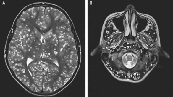 un-joven-muere-por-la-presencia-de-una-plaga-de-gusanos-en-el-cerebro