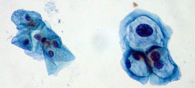 Virus del Papiloma Humano (VPH).