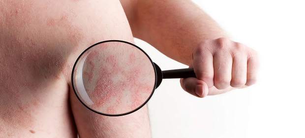 Psoriasis, enfermedad inflamatoria