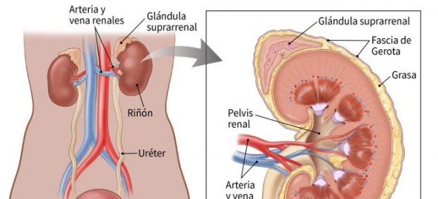 Riñón afectado por sarcoma