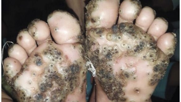 una-nina-sufre-una-grave-infeccion-en-los-pies-provocada-por-un-parasito-tras-jugar-descalza-en-una-pocilga