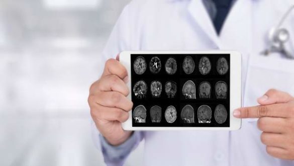 descubren-un-tipo-de-demencia-que-se-confunde-con-el-alzheimer