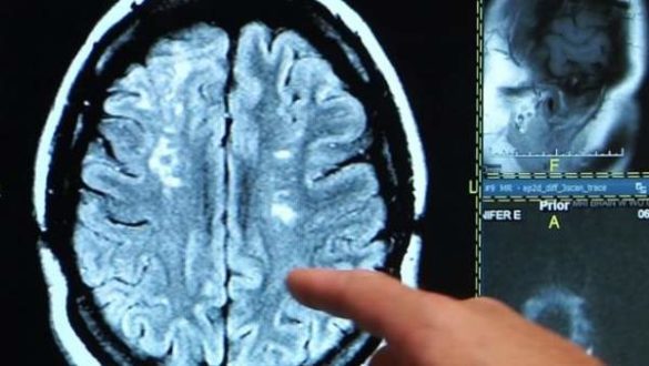 realizan-un-mapa-completo-de-como-el-alzheimer-afecta-al-cerebro