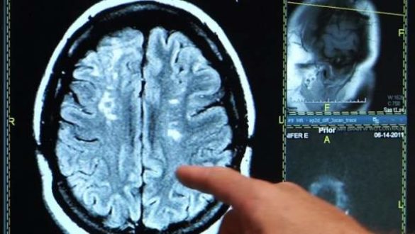 que-es-un-ictus-sintomas-como-actuar-y-prevencion