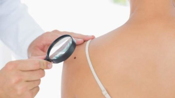 senales-para-sospechar-si-un-lunar-puede-ser-un-melanoma