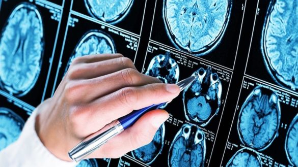 descubren-un-mecanismo-que-acelera-el-alzheimer