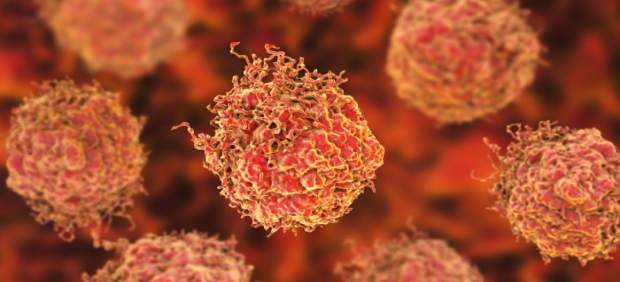 Una dosis única de radioterapia dirigida es segura y eficaz para el cáncer de próstata, según un estudio