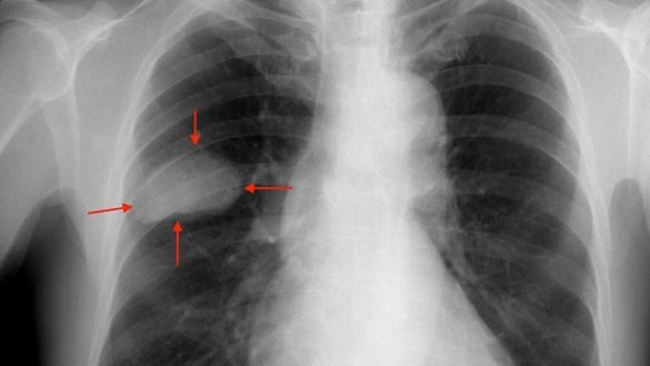 la-supervivencia-del-cancer-de-pulmon-avanzado-empieza-a-contarse-en-anos