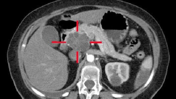 la-terapia-personalizada-irrumpe-en-el-agresivo-cancer-de-pancreas
