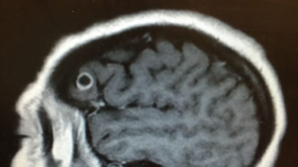 los-medicos-abrieron-el-craneo-de-una-paciente-para-eliminar-un-cancer-y-encontraron-una-tenia