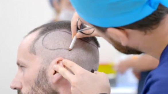 los-dermatologos-advierten-cuidado-con-los-trasplantes-de-pelo-baratos