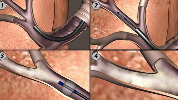 implantan-en-madrid-una-tecnica-pionera-para-tratar-el-enfisema-pulmonar-severo