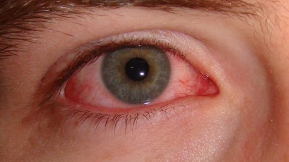 conjuntivitis-los-enemigos-de-tus-ojos-este-verano