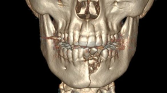 la-explosion-de-su-cigarro-electronico-le-fractura-la-mandibula-y-le-deja-la-boca-8216sellada8217