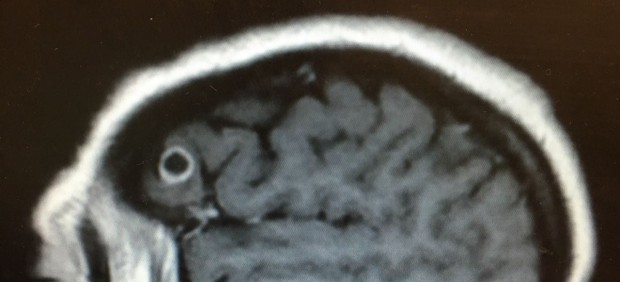 Escáner que muestra el cráneo con la tenia (el círculo que se diferencia en el cerebro). 