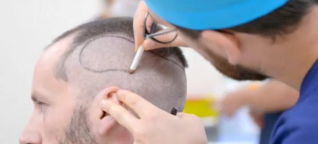 Pruebas para transplante de pelo