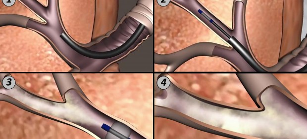 El pulmón tras la intervención
