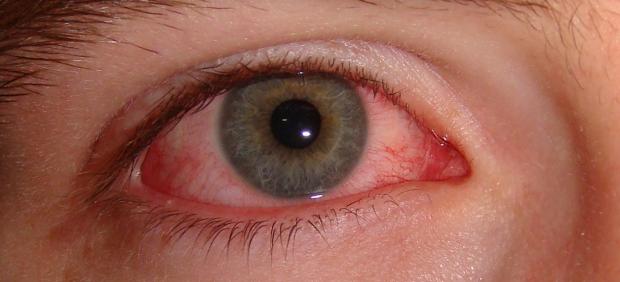 Conjuntivitis