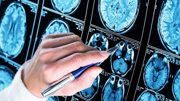 descubren-una-esperanzadora-via-para-tratar-el-alzheimer-en-etapas-tempranas