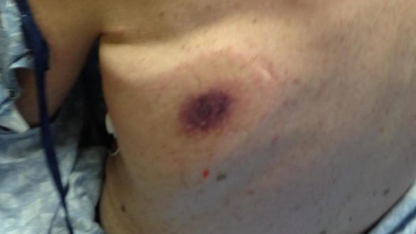 un-hombre-muere-48-horas-despues-de-infectarse-con-una-bacteria-8216comecarne8217-en-la-playa