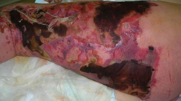 que-es-y-cuales-son-los-sintomas-de-una-infeccion-por-la-rara-pero-peligrosa-bacteria-8216comecarne8217