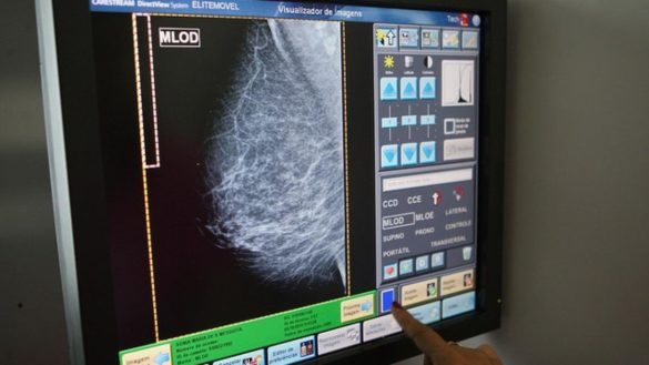 le-diagnostican-cancer-por-error-y-tras-una-mastectomia-y-quimioterapia-descubren-que-estaba-sana