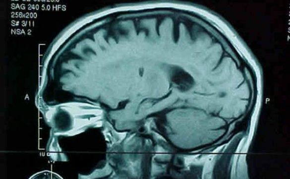 la-terapia-cart-acaba-con-el-cancer-cerebral