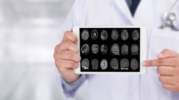 investigadores-logran-detectar-el-alzheimer-temprano-a-traves-de-un-analisis-de-sangre